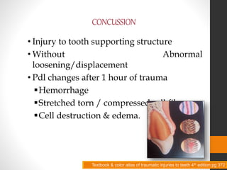 CONCUSSION
• Injury to tooth supporting structure
• Without Abnormal
loosening/displacement
• Pdl changes after 1 hour of trauma
Hemorrhage
Stretched torn / compressed pdl fibers
Cell destruction & edema.
Textbook & color atlas of traumatic injuries to teeth 4th edition pg 372
 