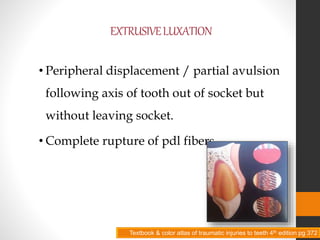 EXTRUSIVELUXATION
• Peripheral displacement / partial avulsion
following axis of tooth out of socket but
without leaving socket.
• Complete rupture of pdl fibers.
Textbook & color atlas of traumatic injuries to teeth 4th edition pg 372
 