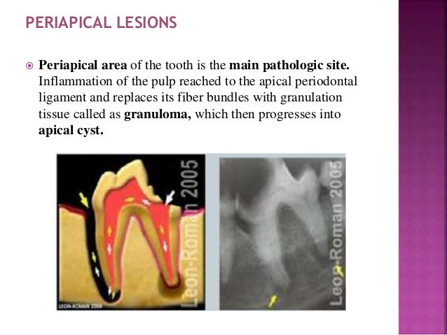 periodontal ligament periodontal ligament