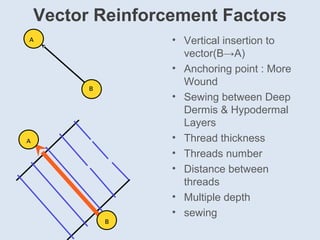 Vector Reinforcement Factors
• Vertical insertion to
vector(B→A)
• Αnchoring point : More
Wound
• Sewing between Deep
Dermis & Hypodermal
Layers
• Thread thickness
• Threads number
• Distance between
threads
• Multiple depth
• sewing
A
B
A
B
 