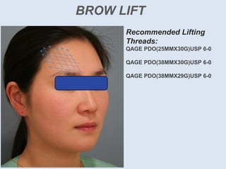 BROW LIFT
Recommended Lifting
Threads:
QAGE PDO(25MMX30G)USP 6-0
QAGE PDO(38MMX30G)USP 6-0
QAGE PDO(38MMX29G)USP 6-0
 