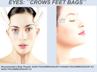 EYES: ``CROWS FEET BAGS``
Recommended Lifting Threads: QAGE PDO(25MMX30G)USP 6-0/QAGE PDO(38MMX30G)USP 6-0
QAGE PDO(38MMX29G)USP 6-0
 