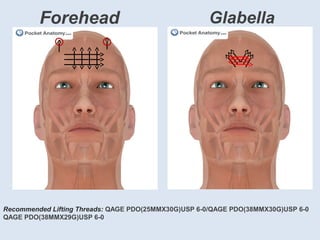 Forehead Glabella
Recommended Lifting Threads: QAGE PDO(25MMX30G)USP 6-0/QAGE PDO(38MMX30G)USP 6-0
QAGE PDO(38MMX29G)USP 6-0
 