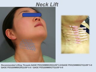 Neck Lift
Recommended Lifting Threads:QAGE PDO(50MMX29G)USP 6-0/QAGE PDO(50MMX27G)USP 5-0
QAGE PDO(60MMX29G)USP 6-0 / QAGE PDO(60MMX27G)USP 6-0
 