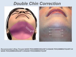 Double Chin Correction
Recommended Lifting Threads:QAGE PDO(38MMX29G)USP 6-0/QAGE PDO(38MMX27G)USP 6-0
QAGE PDO(50MMX29G)USP 6-0/QAGE PDO(50MMX27G)USP
 
