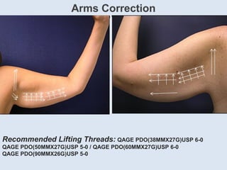 Arms Correction
Recommended Lifting Threads: QAGE PDO(38MMX27G)USP 6-0
QAGE PDO(50MMX27G)USP 5-0 / QAGE PDO(60MMX27G)USP 6-0
QAGE PDO(90MMX26G)USP 5-0
 
