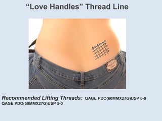 “Love Handles” Thread Line
Recommended Lifting Threads: QAGE PDO(60MMX27G)USP 6-0
QAGE PDO(50MMX27G)USP 5-0
 
