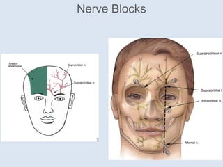 Nerve Blocks
 