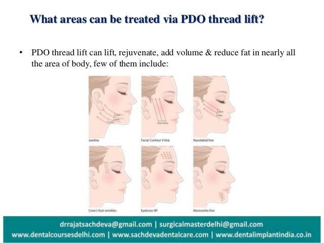 what is pdo thread lift what is pdo thread lift