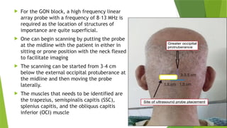  For the GON block, a high frequency linear
array probe with a frequency of 8–13 MHz is
required as the location of structures of
importance are quite superficial.
 One can begin scanning by putting the probe
at the midline with the patient in either in
sitting or prone position with the neck flexed
to facilitate imaging
 The scanning can be started from 3–4 cm
below the external occipital protuberance at
the midline and then moving the probe
laterally.
 The muscles that needs to be identified are
the trapezius, semispinalis capitis (SSC),
splenius capitis, and the obliquus capitis
inferior (OCI) muscle
 