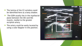  The lamina of the C2 vertebra could
be identified here as a bony shadow.
 The GON usually lies in the myofascial
plane between the OCI and SSC
muscle, medial to the greater
occipital artery.
 The artery could be easily located by
using a color Doppler in this position.
 