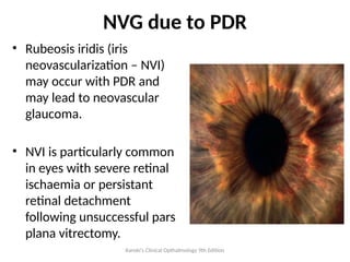 Proliferative Diabetic Ratinopathy By Dr. Eva | PPTX
