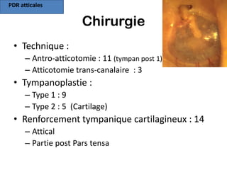 PDR atticales

                      Chirurgie
 • Technique :
      – Antro-atticotomie : 11 (tympan post 1)
      – Atticotomie trans-canalaire : 3
 • Tympanoplastie :
      – Type 1 : 9
      – Type 2 : 5 (Cartilage)
 • Renforcement tympanique cartilagineux : 14
      – Attical
      – Partie post Pars tensa
 