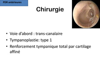PDR antérieures

                  Chirurgie


  • Voie d’abord : trans-canalaire
  • Tympanoplastie: type 1
  • Renforcement tympanique total par cartilage
    affiné
 