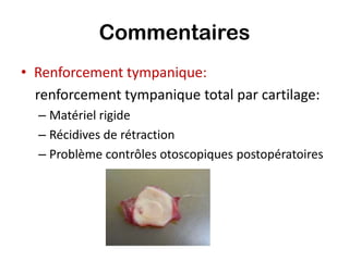 Commentaires
• Renforcement tympanique:
  renforcement tympanique total par cartilage:
  – Matériel rigide
  – Récidives de rétraction
  – Problème contrôles otoscopiques postopératoires
 