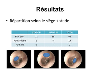 Résultats
• Répartition selon le siège + stade

                   STADE II   STADE III   TOTAL
     PDR post        11          38        49
    PDR atticale      6          8         14
      PDR ant         2           -         2
 