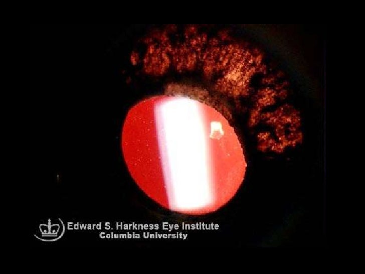 Pigment Dispersion Syndrome & Pigmentary