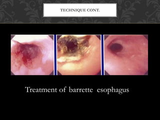 TECHNIQUE CONT.
Treatment of barrette esophagus
 