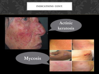 INDICATIONS CONT.
Actinic
keratosis
Mycosis
 