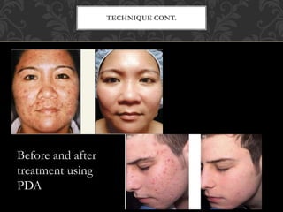 TECHNIQUE CONT.
Before and after
treatment using
PDA
 