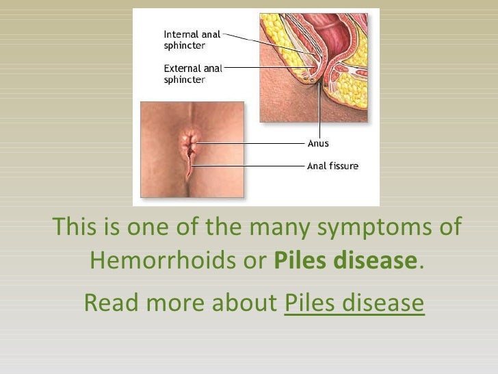 piles disease symptoms causes