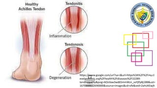 https://www.google.com/url?sa=i&url=https%3A%2F%2Fmy.cl
evelandclinic.org%2Fhealth%2Fdiseases%2F22289-
tendinopathy&psig=AOvVaw3wd65mmWzn_vxYjPpBj18B&ust=
1670888822690000&source=images&cd=vfe&ved=2ahUKEwjh
 