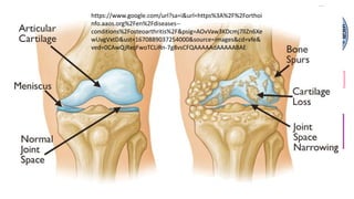 https://www.google.com/url?sa=i&url=https%3A%2F%2Forthoi
nfo.aaos.org%2Fen%2Fdiseases--
conditions%2Fosteoarthritis%2F&psig=AOvVaw3KDcmj7lIZn6Xe
wUvgVxtD&ust=1670889037254000&source=images&cd=vfe&
ved=0CAwQjRxqFwoTCLiRn-7g8vsCFQAAAAAdAAAAABAE
 