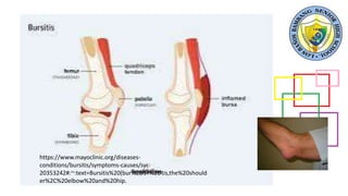 https://www.mayoclinic.org/diseases-
conditions/bursitis/symptoms-causes/syc-
20353242#:~:text=Bursitis%20(bur%2DSY%2Dtis,the%20should
er%2C%20elbow%20and%20hip.
 