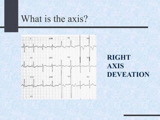 What is the axis?
RIGHT
AXIS
DEVEATION
 