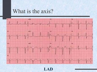 What is the axis?
LAD
 