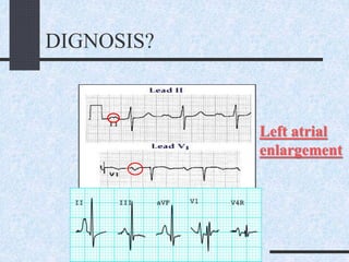 DIGNOSIS?
Left atrial
enlargement
 