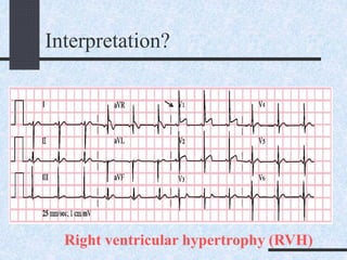Interpretation?
Right ventricular hypertrophy (RVH)
 