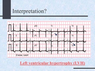 Interpretation?
Left ventricular hypertrophy (LVH)
 
