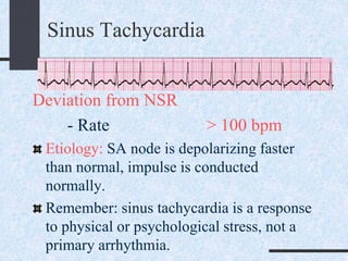 Sinus Tachycardia
Deviation from NSR
- Rate > 100 bpm
Etiology: SA node is depolarizing faster
than normal, impulse is conducted
normally.
Remember: sinus tachycardia is a response
to physical or psychological stress, not a
primary arrhythmia.
 