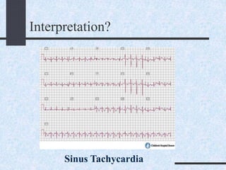 Interpretation?
Sinus Tachycardia
 