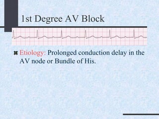 1st Degree AV Block
Etiology: Prolonged conduction delay in the
AV node or Bundle of His.
 