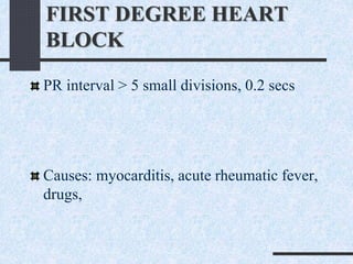 FIRST DEGREE HEART
BLOCK
PR interval > 5 small divisions, 0.2 secs
Causes: myocarditis, acute rheumatic fever,
drugs,
 