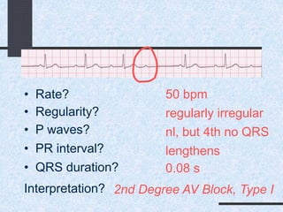 50 bpm• Rate?
• Regularity? regularly irregular
nl, but 4th no QRS
0.08 s
• P waves?
• PR interval? lengthens
• QRS duration?
Interpretation? 2nd Degree AV Block, Type I
 