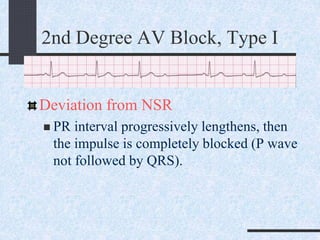 2nd Degree AV Block, Type I
Deviation from NSR
 PR interval progressively lengthens, then
the impulse is completely blocked (P wave
not followed by QRS).
 