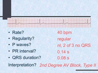 40 bpm• Rate?
• Regularity? regular
nl, 2 of 3 no QRS
0.08 s
• P waves?
• PR interval? 0.14 s
• QRS duration?
Interpretation? 2nd Degree AV Block, Type II
 