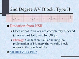 2nd Degree AV Block, Type II
Deviation from NSR
 Occasional P waves are completely blocked
(P wave not followed by QRS).
 Etiology: Conduction is all or nothing (no
prolongation of PR interval); typically block
occurs in the Bundle of His.
MOBITZ TYPE 2
 