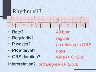 Rhythm #13
40 bpm• Rate?
• Regularity? regular
no relation to QRS
wide (> 0.12 s)
• P waves?
• PR interval? none
• QRS duration?
Interpretation? 3rd Degree AV Block
 
