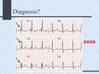 Diagnosis?
RBBB
 