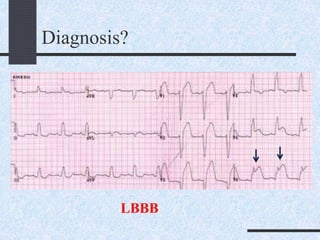 Diagnosis?
LBBB
 