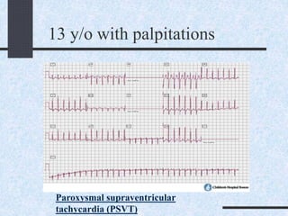 13 y/o with palpitations
Paroxysmal supraventricular
tachycardia (PSVT)
 