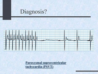 Diagnosis?
Paroxysmal supraventricular
tachycardia (PSVT)
 