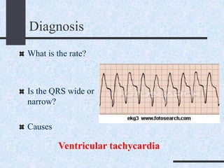 Diagnosis
What is the rate?
Is the QRS wide or
narrow?
Causes
Ventricular tachycardia
 