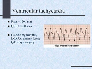 Ventricular tachycardia
Rate > 120 / min
QRS > 0.08 secs
Causes: myocarditis,
LCAPA, tumour, Long
QT, drugs, surgery
 