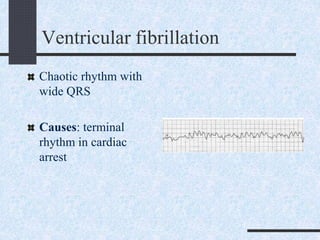 Ventricular fibrillation
Chaotic rhythm with
wide QRS
Causes: terminal
rhythm in cardiac
arrest
 