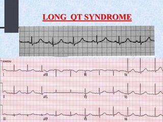 LONG QT SYNDROME
 